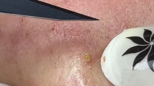 Ручное удаление черных точек и комедонов на лбу