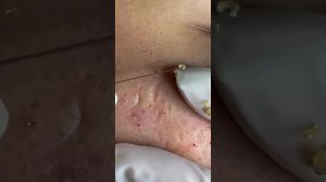Выдавливание черных точек