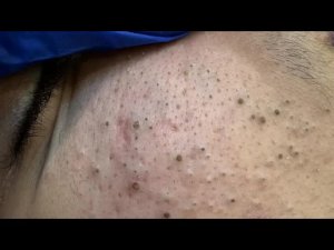 Корейский уход за кожей при прыщах и черных точках | Натуральные средства