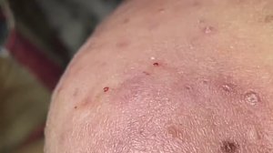 Механическое удаление прыщей и черных точек на подбородке