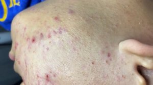 297 • Acne collection • АСМР • Relax Spa
