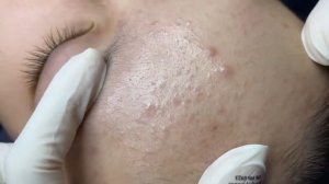 293 • Acne collection • АСМР • Relax Spa