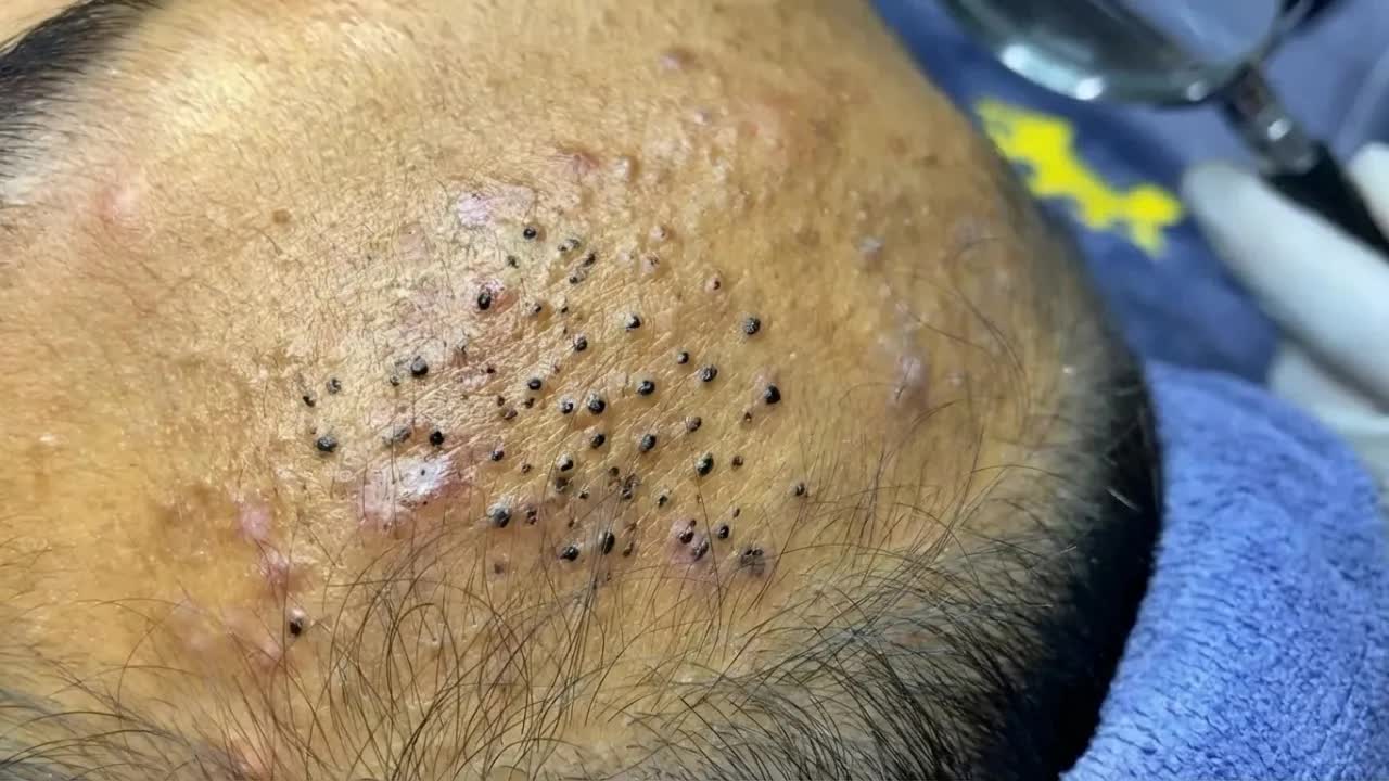 Удаление черных точек в Sac Dep Spa