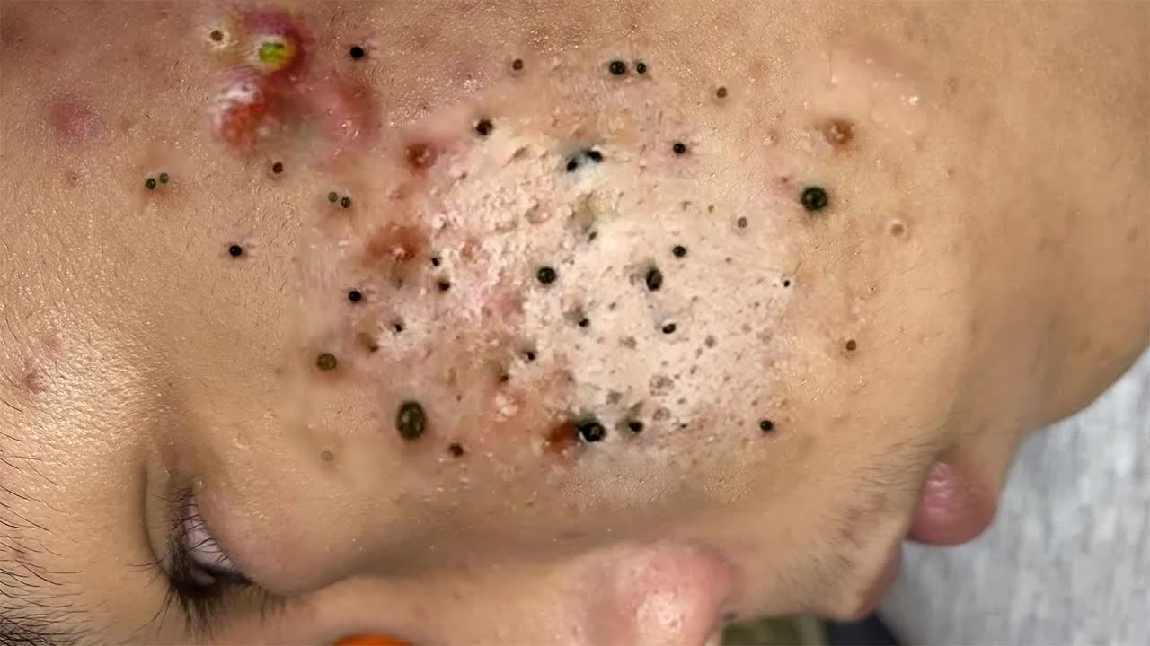 Экстремальное удаление черных точек: расслабляющее видео #1018 смотреть онлайн