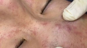 289 • Acne collection • АСМР • Relax Spa