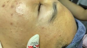 302 • Acne collection • АСМР • Relax Spa