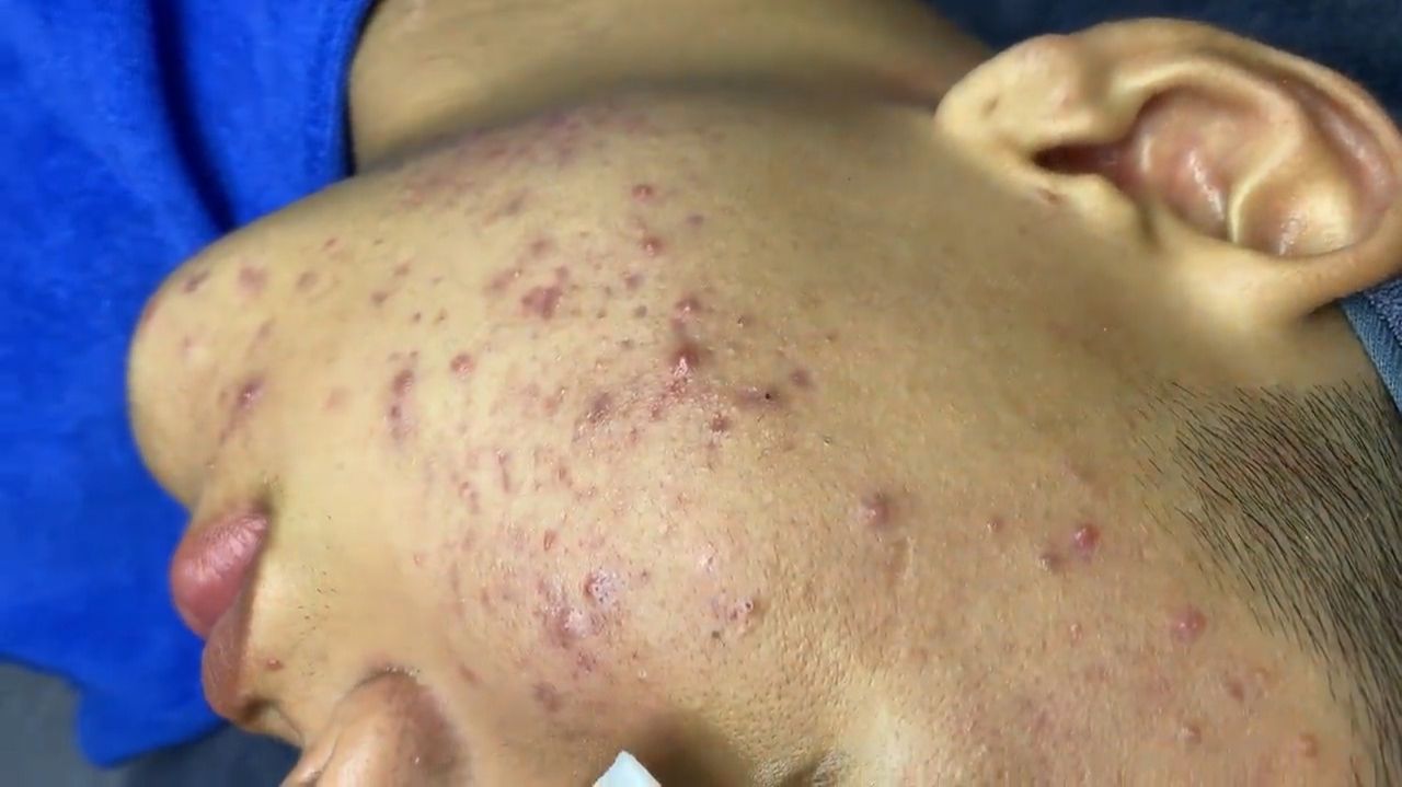 291 • Acne collection • АСМР • Relax Spa смотреть онлайн