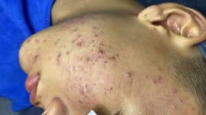 291 • Acne collection • АСМР • Relax Spa
