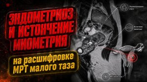 ЭНДОМЕТРИОЗ матки и ИСТОНЧЕНИЕ МИОМЕТРИЯ на расшифровке МРТ малого таза у женщин