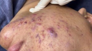 311 • Acne collection • АСМР • Relax Spa
