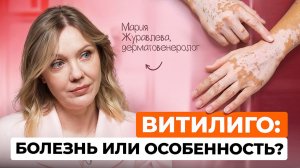 Витилиго: почему появляются белые пятна и как восстановить цвет кожи