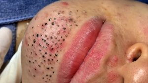 Удаление черных точек в Sac Dep Spa