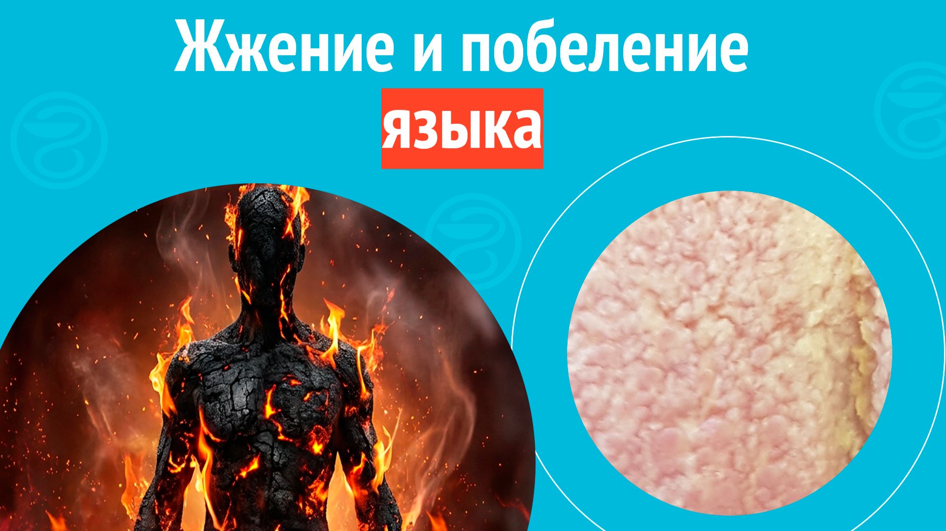 👅 Жжение и побеление языка. Клинический случай № 1816