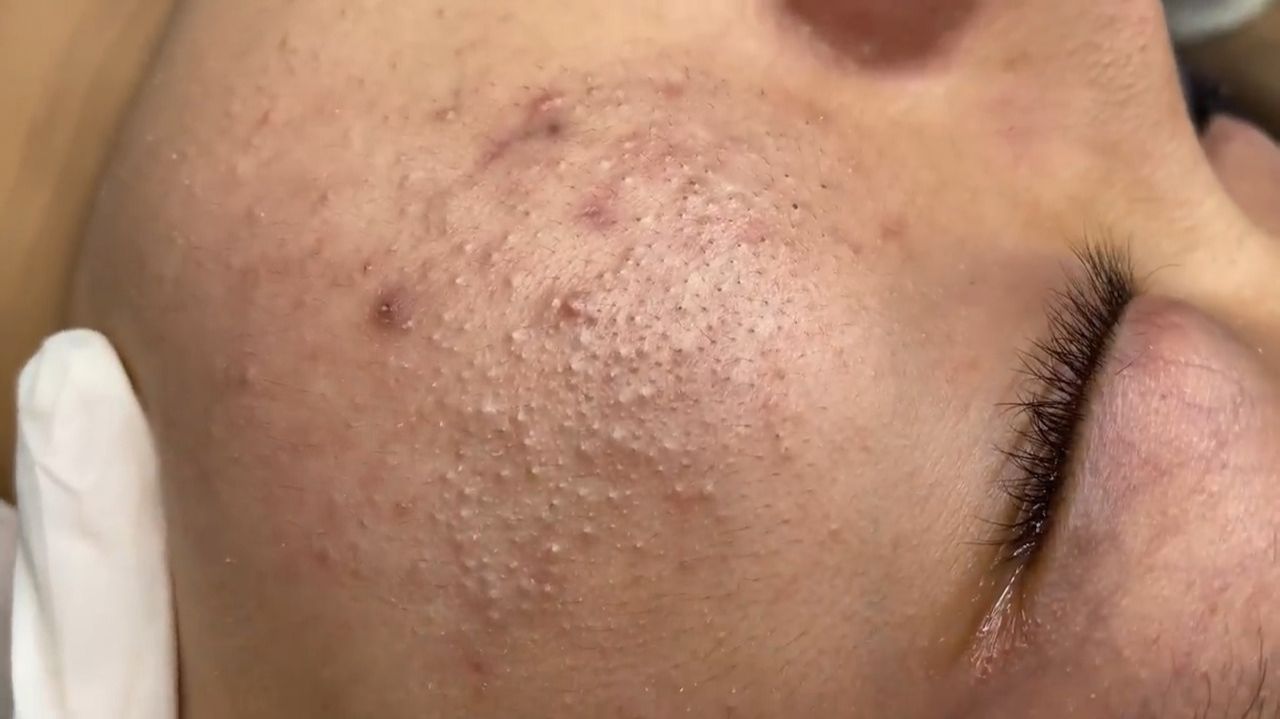 312 • Acne collection • АСМР • Relax Spa смотреть онлайн