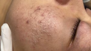 312 • Acne collection • АСМР • Relax Spa