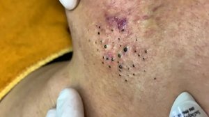Удаление черных точек в Sac Dep Spa