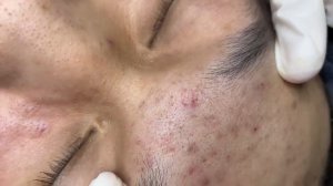 303 • Acne collection • АСМР • Relax Spa