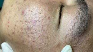 298 • Acne collection • АСМР • Relax Spa