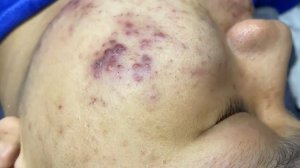 301 • Acne collection • АСМР • Relax Spa