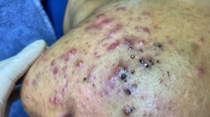 Извлечение черных точек в Sac Dep Spa @877