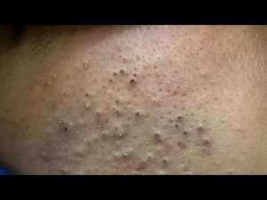 Агрессивная чистка пор | Удаление черных точек и уход за кожей