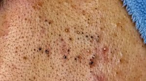 Извлечение черных точек в Sac Dep Spa