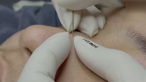 #461 Удаление акне. Экстракция комедонов. Подкожные прыщи. Чистка от черных точек