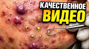 Отличное удаление прыщей часть. качество!