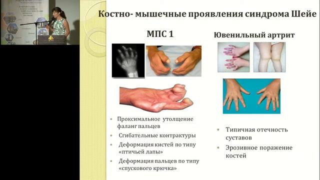 Завгородня Н  Мукополісахаридоз І типу що потрібно знати педіатру та сімейному лікарю
