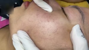 Механическое удаление прыщей на лице
