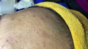 Удаление комедонов с лица — множественные образования
