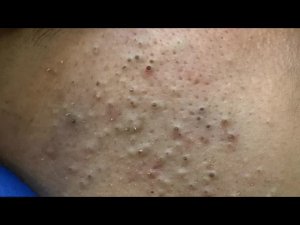 Глубокое очищение от черных точек и прыщей | Корейский уход за кожей
