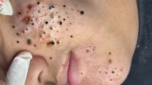Экстремальное удаление черных точек 🧖 Завораживающее расслабление