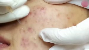 Механическое удаление комедонов у косметолога