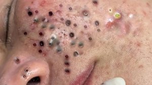 Экстремальное удаление черных точек: расслабление и удовлетворение
