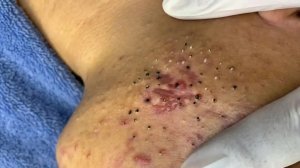 Удаление черных точек в Sac Dep Spa