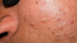 Черные точки и прыщи: глубокое очищение пор