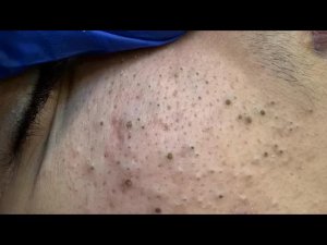 Удаление сальных нитей | Корейский уход за кожей