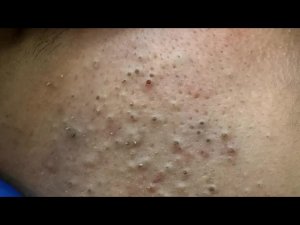 Корейский уход за кожей: от прыщей и чёрных точек
