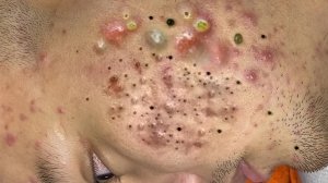 Экстремальное удаление черных точек: удовлетворение и релаксация