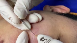 Удаление прыщей и комедонов у подростка
