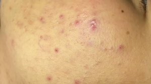 Удаление кожных образований на лице