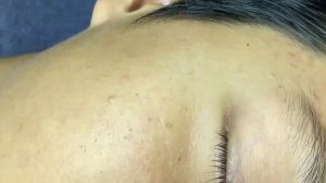 Acne collection • A012 • Архив SacDepSpa • АСМР