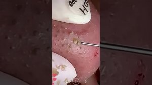 Уход за кожей | Удаление черных точек #800 #tweezers skincare #blackheads