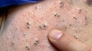 Уход за лицом для пожилых мужчин: удаление чёрных точек в спа