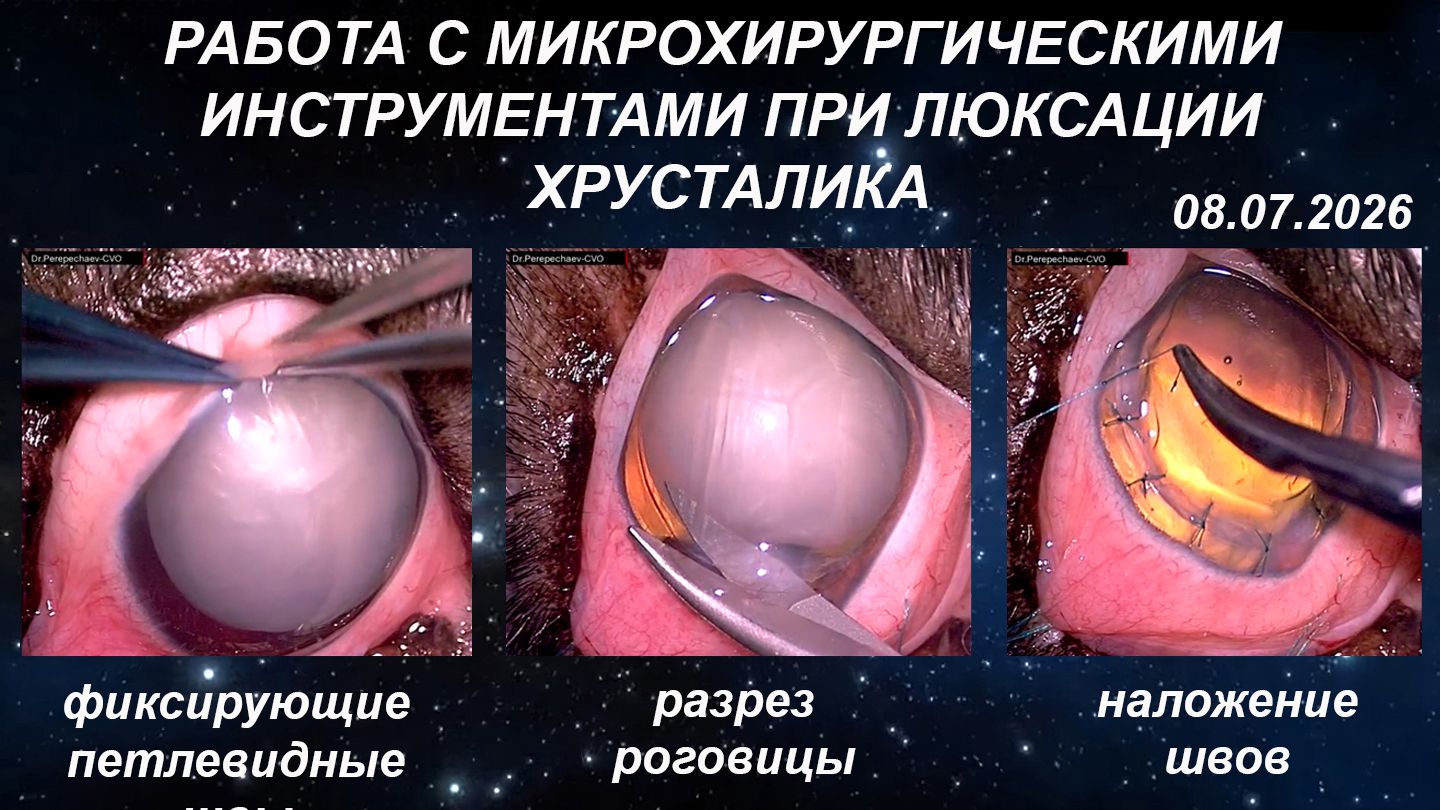 Работа с микрохирургическими офтальмологическими инструментами при люксации хрусталика