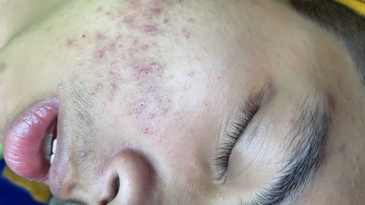 Acne collection • A004 • Архив SacDepSpa • АСМР смотреть онлайн
