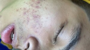 Acne collection • A004 • Архив SacDepSpa • АСМР