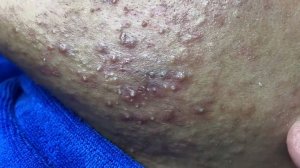 Acne collection • A001 • Архив SacDepSpa • АСМР