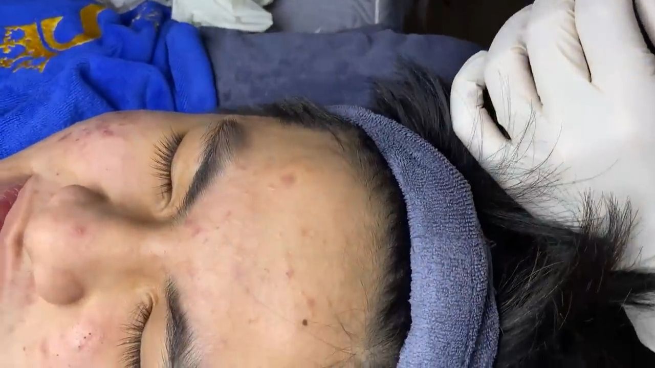 Acne collection • A008 • Архив SacDepSpa • АСМР смотреть онлайн